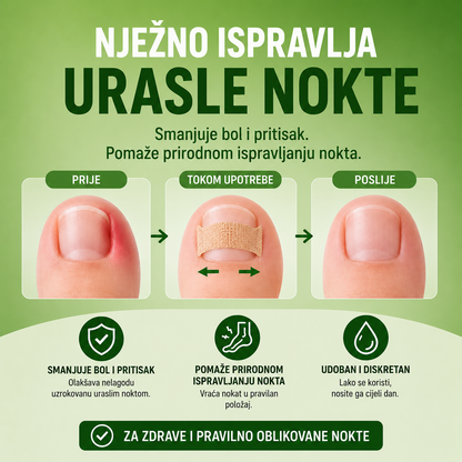 Flasteri za Urasle Nokte – Set od 80 komada